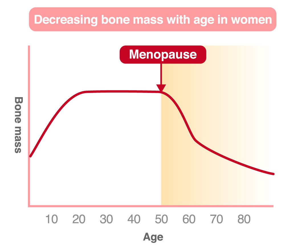 Graphic showing the effect of osteoporosis on women's bones during menopause