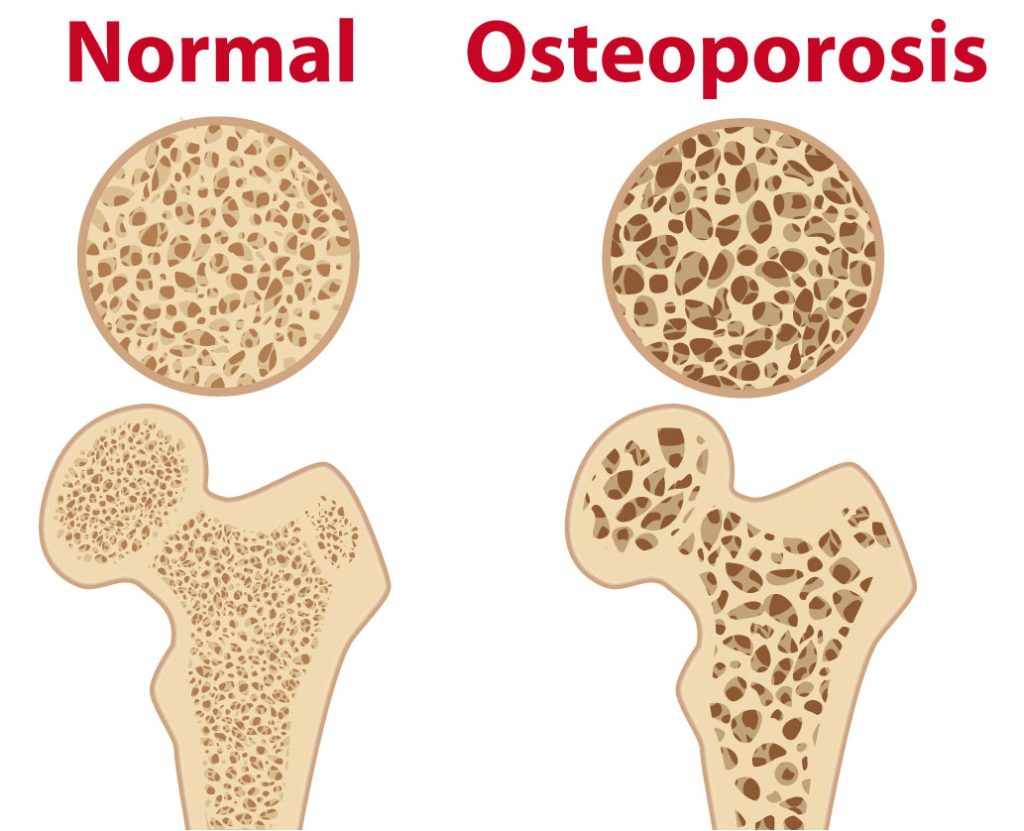 Graphic showing the effect of osteoporosis on women's bones during menopause